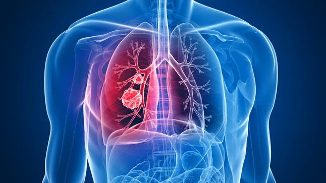 Crece la preocupación por el aumento de casos de cáncer de pulmón en personas no fumadoras